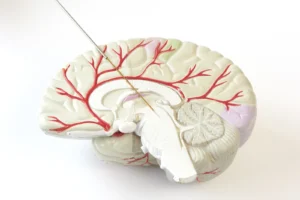 Medical electrode positioned above a model of the human brain