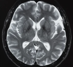 MRI scan showing the structure of the human brain