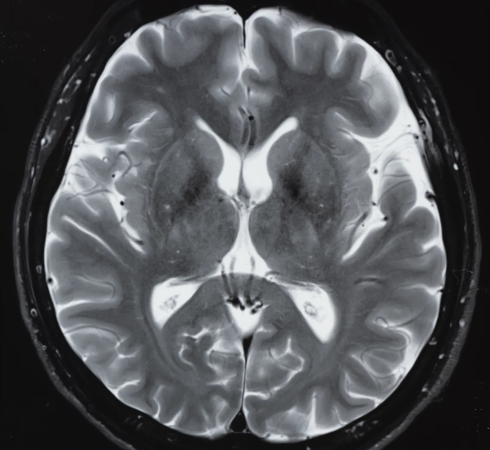 MRI scan showing the structure of the human brain